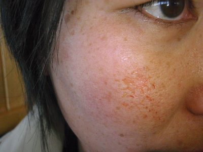 Monica's cheek post-injury.  Monica face-planted on a...